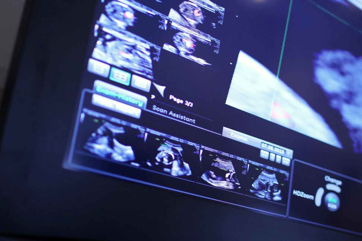 cmut ultrasound