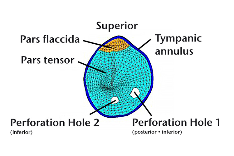 Perforated tympanic membrane model